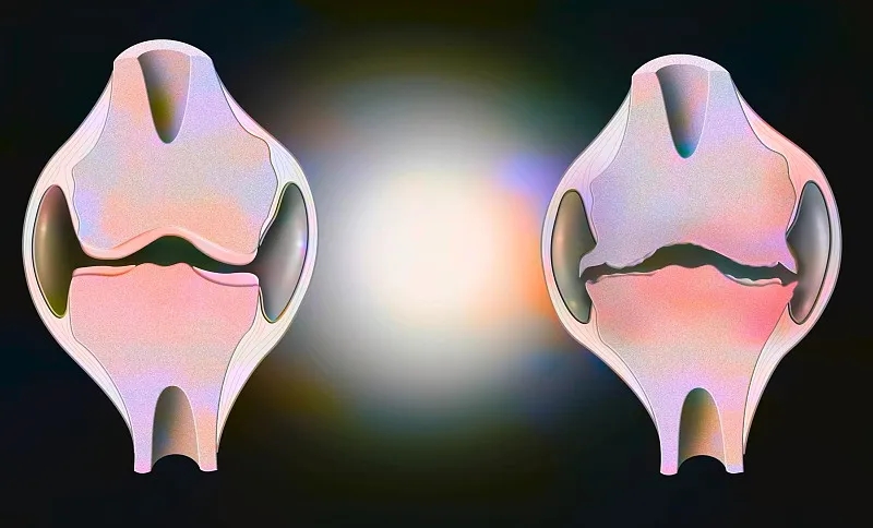 盘点:2020~2023年干细胞治疗骨关节炎的临床研究进展 盘点:2020~2023年干细胞治疗骨关节炎的临床研究进展