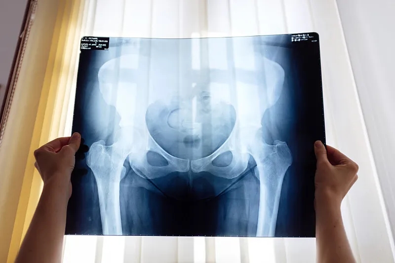 干细胞治疗股骨头缺血性坏死的临床疗效研究