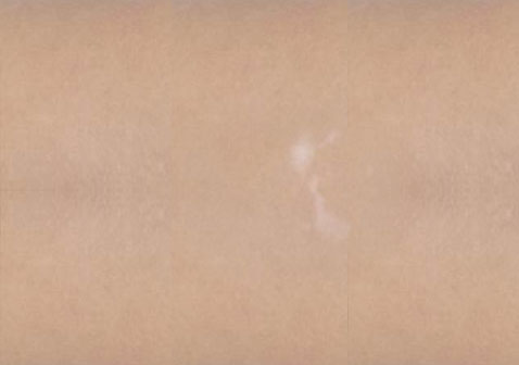 白癜风白斑初期症状轻微小斑点,无色素。 白癜风白斑初期症状轻微小斑点,无色素。