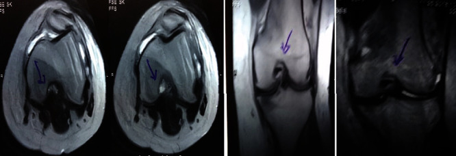 图1：治疗前MRI显示内侧和外侧半月板后角的III级撕裂。