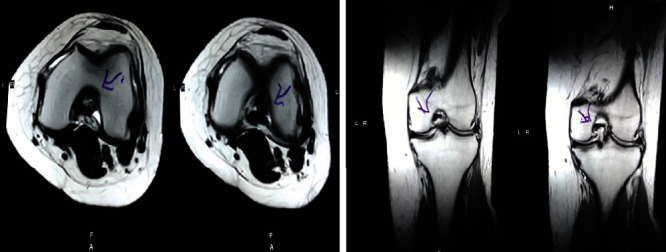 图2：治疗后MRI显示内侧和外侧半月板后角的撕裂有所改善。患者经历了症状改善以及进行日常生活活动的能力增强。