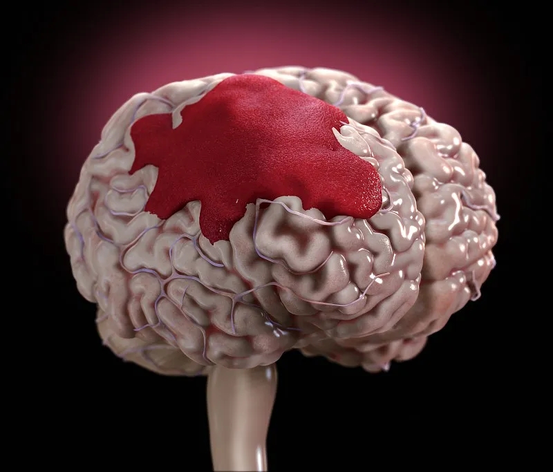 神经干细胞移植在治疗脑出血中的应用研究进展