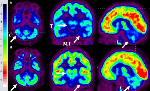 图6：ASD患者在细胞治疗前和细胞治疗后6个月进行的FDG-PET/CT大脑扫描的代表性图像。