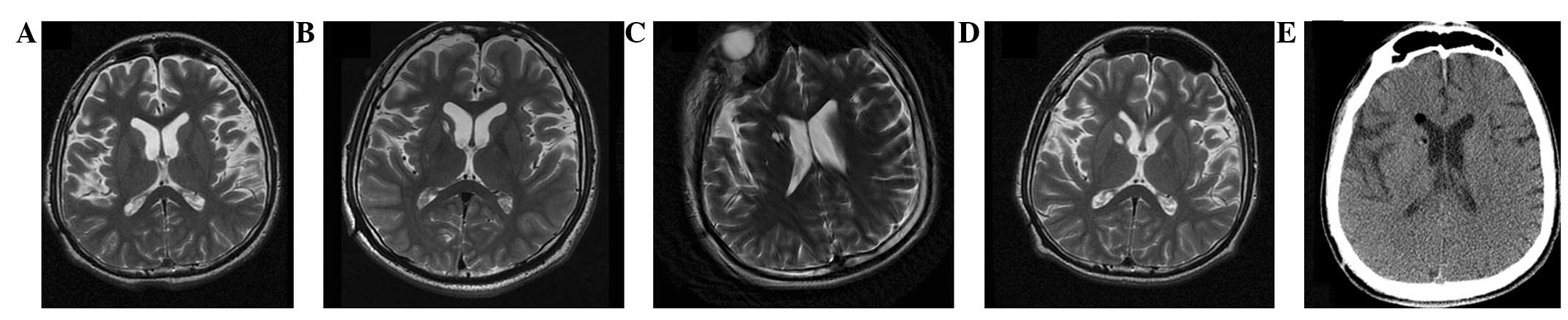 图2：-T2加权磁共振成像 (MRI)