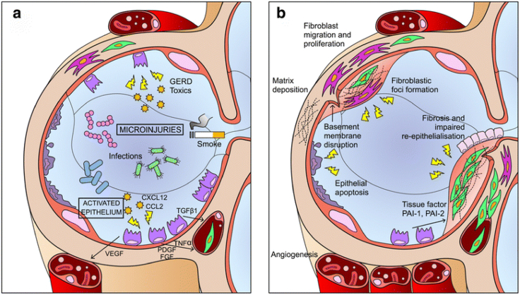 图1：IPF发病机制示意图