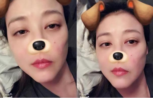 △ 周海媚之前发布的自拍照中也隐约可见面部红斑 △ 周海媚之前发布的自拍照中也隐约可见面部红斑