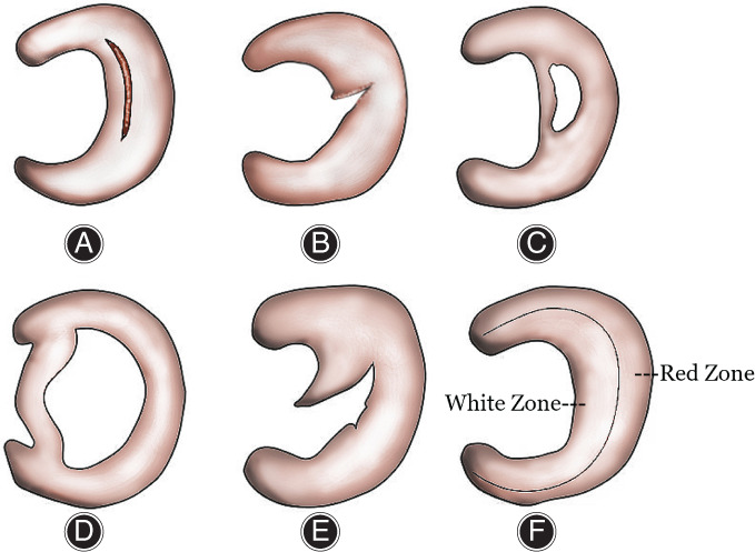 图2：半月板的解剖结构和损伤类型