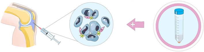 使用MSCs治疗半月板损伤的流程