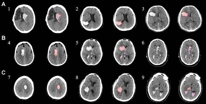 图1：每个间充质干细胞治疗患者按组的原始非对比计算机断层扫描和分割结果