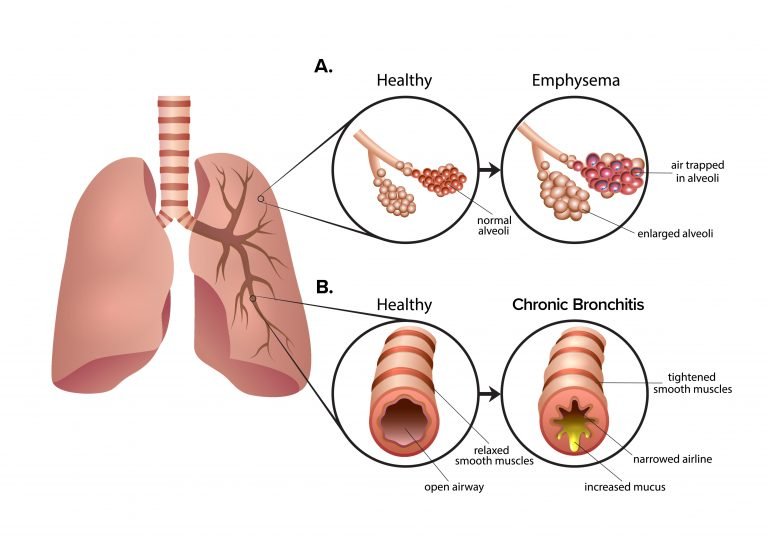 图2：慢性阻塞性肺疾病 (COPD) 是一组导致呼吸困难的肺部疾病。A.肺气肿导致肺泡气囊受损和僵硬。空气被困在肺泡中，导致呼气困难。B.慢性支气管炎会导致气道肿胀和粘液增多。多余的粘液使呼吸困难并导致慢性咳嗽