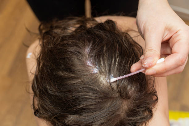 自体干细胞治疗女性雄激素性脱发的短期临床评估