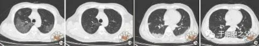 细胞输注后,炎症指标改善,复查胸部CT提示双肺病灶较前吸收,呼吸道症状改善,新型冠状病毒核酸检测连续2次阴性,治愈出院。 细胞输注后,炎症指标改善,复查胸部CT提示双肺病灶较前吸收,呼吸道症状改善,新型冠状病毒核酸检测连续2次阴性,治愈出院。