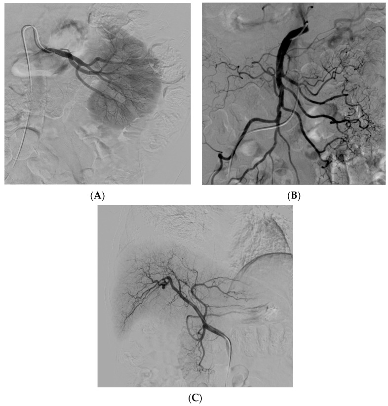 图2：肾 ( A )、肠系膜上动脉 ( B ) 和肝动脉 ( C ) 的血管造影插管