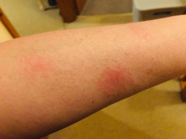 系统性红斑狼疮的最佳治疗方法是什么？