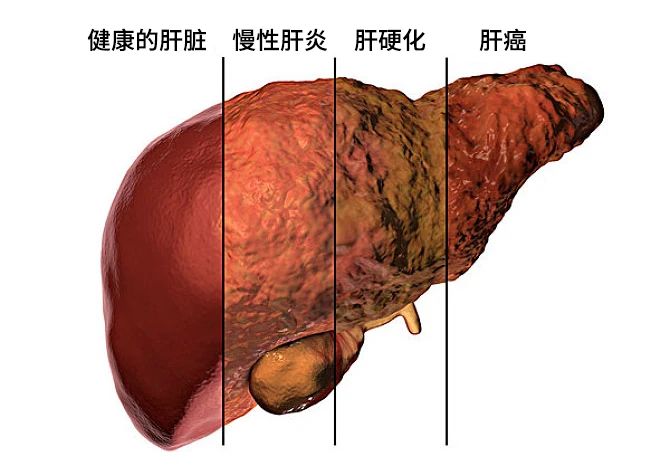 不同原因的肝损害发展主要分为三个阶段：肝炎-肝硬化-肝癌。