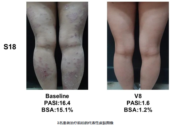 患者治疗前后的代表性皮肤图像