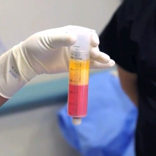 购买和使用低温保存（冷冻）的脐带干细胞是许多干细胞治疗提供者的另一种流行选择。