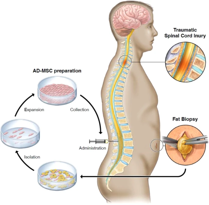 通过活检、AD-MSC 分离、扩增和收集以及治疗管理来获取脂肪的过程图解 通过活检、AD-MSC 分离、扩增和收集以及治疗管理来获取脂肪的过程图解