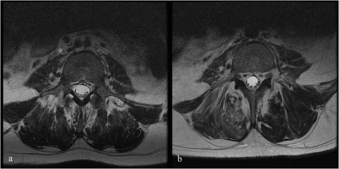 6号患者腰椎T2加权磁共振成像 (MRI) 的轴向视图，该患者在L4-S1输注后出现马尾夹紧。L4水平的输注前 MRI 扫描。b1年随访时L4水平的输注后 MRI扫描。