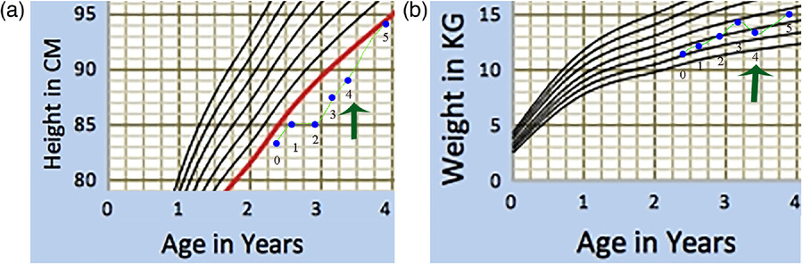 图1：一名患有严重III型OI的男孩的生长曲线图。