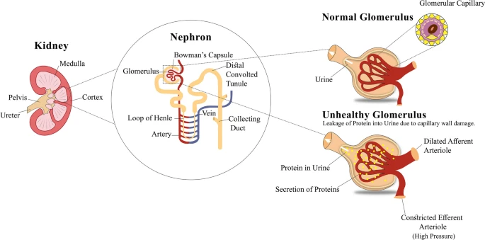 尿液中白蛋白的过度分泌及其与肾小球的关系如图1所示。