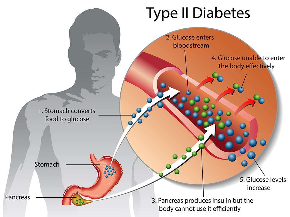 2型糖尿病的症状、原因、治疗