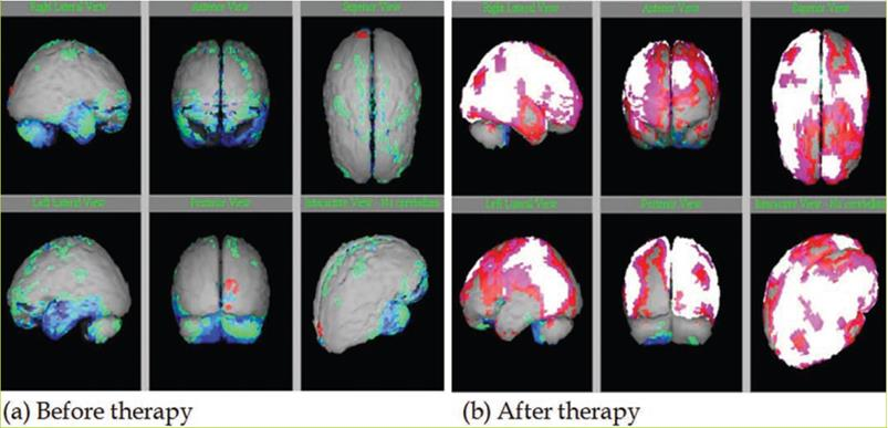 图4：一名三岁的ASD患者在两次治疗后的脑部SPECT扫描图。人类胚胎干细胞治疗；绿色、浅蓝色、深蓝色和黑色表示低渗透区域；灰色表示正常区域；红色、粉红色和白色表示高于正常值的区域。