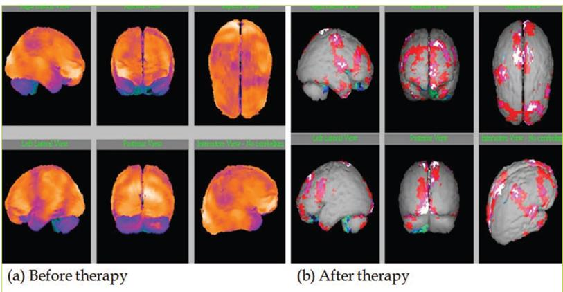 图5：一名10岁患者在被诊断为ASD后的脑部扫描。胚胎干细胞治疗；绿色、浅蓝色、深蓝色和黑色表示低灌注区域；灰色代表正常区域；红色、粉红色和白色代表高于正常区域。