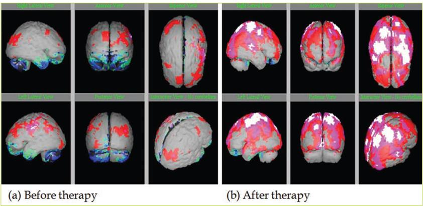 图6：一名4岁患者在诊断为ASD后的脑部扫描；人胚胎干细胞治疗；绿色、浅蓝色、深蓝色和黑色表示低灌注区域；灰色代表正常区域；红色、粉色和白色代表高于正常区域。