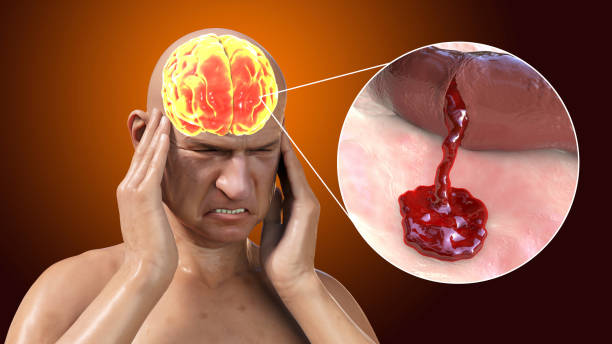 了解缺血性中风的病理生理学：当前疗法的基础和干细胞疗法的机遇