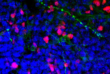 干细胞移植可能是治疗精神分裂症的新方法