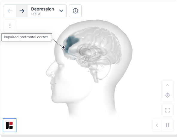 重度抑郁症的特征