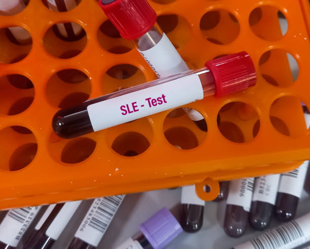 干细胞移植治疗系统性红斑狼疮的临床疗效分析