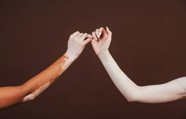 干细胞转换医学杂志:干细胞治疗难治性白癜风安全有效 干细胞转换医学杂志:干细胞治疗难治性白癜风安全有效