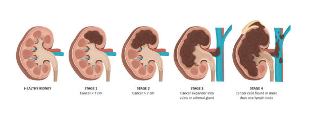 你了解急性肾损伤的3个不同阶段吗？