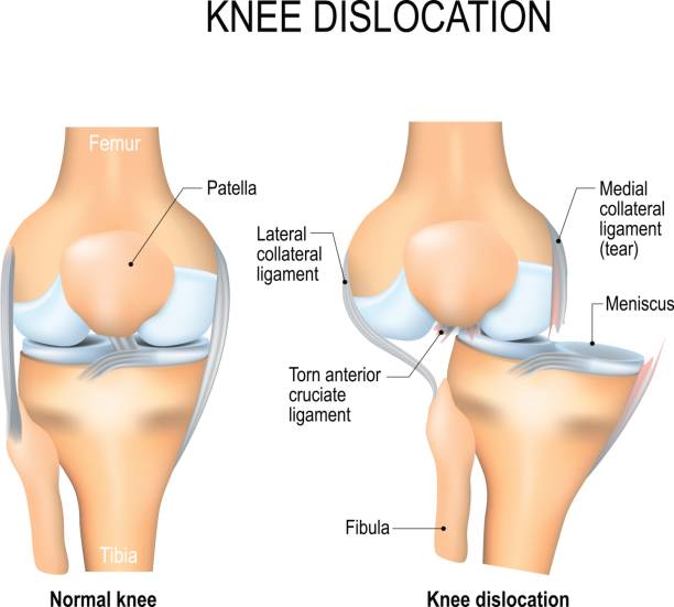 半月板撕裂后该如何恢复? 半月板撕裂后该如何恢复?