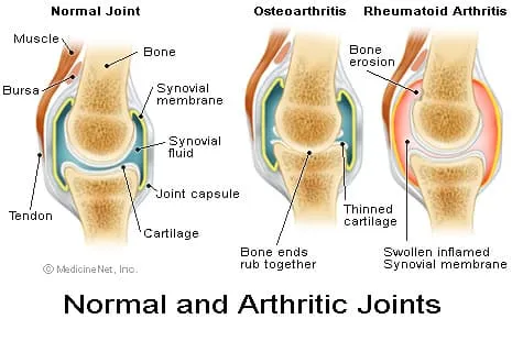 骨关节炎：你真的了解是什么导致你的关节痛吗？
