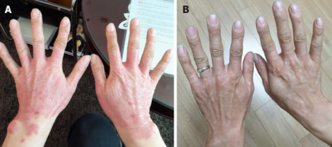 3次干细胞治疗后25年银屑病顽疾得到显著改善! 3次干细胞治疗后25年银屑病顽疾得到显著改善!