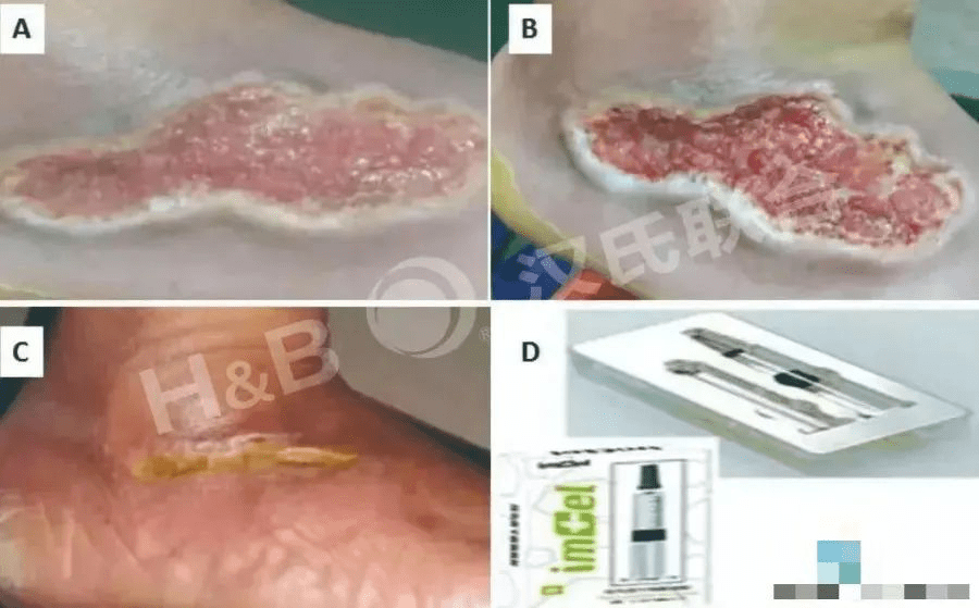 糖尿病足溃疡患者使用胎盘衍生间充质干细胞水凝胶进行三周局部治疗:病例报告。 糖尿病足溃疡患者使用胎盘衍生间充质干细胞水凝胶进行三周局部治疗:病例报告。