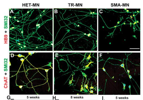 2012年干细胞治疗脊髓性肌萎缩症临床案例