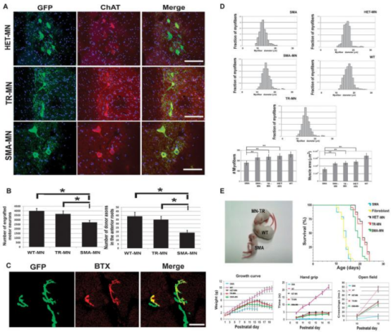 2012年干细胞治疗脊髓性肌萎缩症临床案例