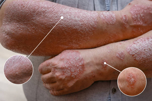 银屑病治疗新策略：干细胞治疗银屑病的临床应用与效果评估