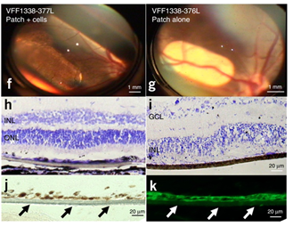 干细胞治疗黄斑变性临床案例 干细胞治疗黄斑变性临床案例