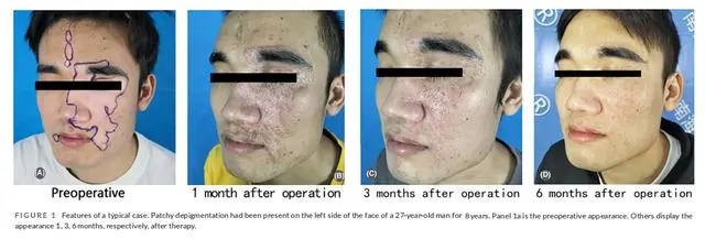 2023年干细胞治疗白癜风临床案例 2023年干细胞治疗白癜风临床案例