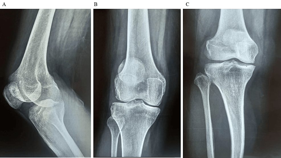 图1:显示了开始干细胞治疗之前的骨骼侧视图和前后视图。 图1:显示了开始干细胞治疗之前的骨骼侧视图和前后视图。