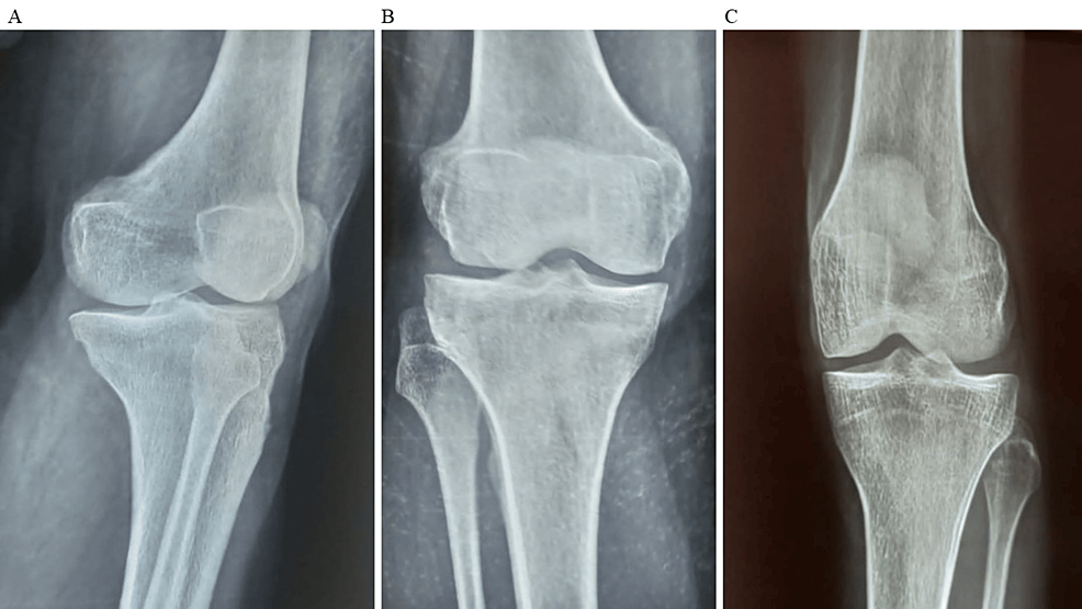 图2:显示了开始干细胞治疗后骨骼的侧视图和前后视图 图2:显示了开始干细胞治疗后骨骼的侧视图和前后视图