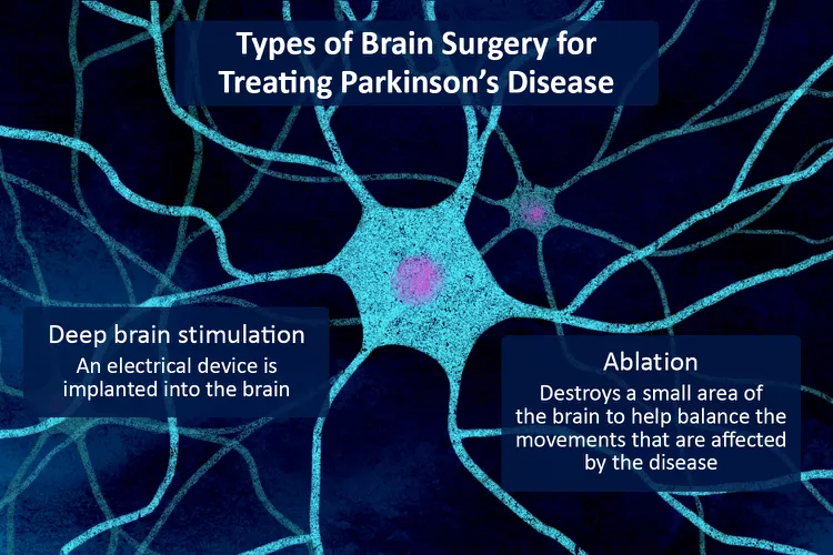 帕金森病的脑部手术：类型、恢复和风险