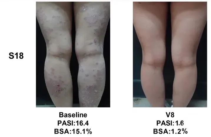 总共47.1% (8/17)的银屑病患者在PASI(皮损面积和严重程度)评分中有至少40%的改善 总共47.1% (8/17)的银屑病患者在PASI(皮损面积和严重程度)评分中有至少40%的改善