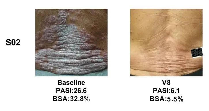 总共47.1% (8/17)的银屑病患者在PASI(皮损面积和严重程度)评分中有至少40%的改善 总共47.1% (8/17)的银屑病患者在PASI(皮损面积和严重程度)评分中有至少40%的改善
