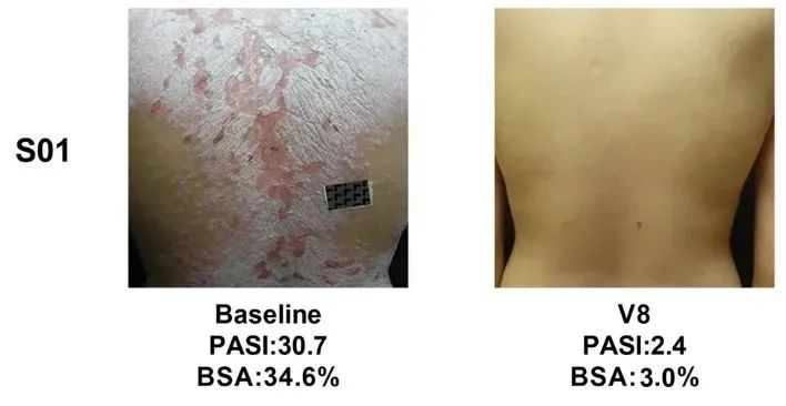 总共47.1% (8/17)的银屑病患者在PASI(皮损面积和严重程度)评分中有至少40%的改善 总共47.1% (8/17)的银屑病患者在PASI(皮损面积和严重程度)评分中有至少40%的改善